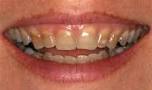 Coloratiile dentare