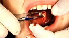 Vindecarea dupa o extractie dentara