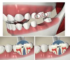 Migrarea dintilor dupa extractia dentara