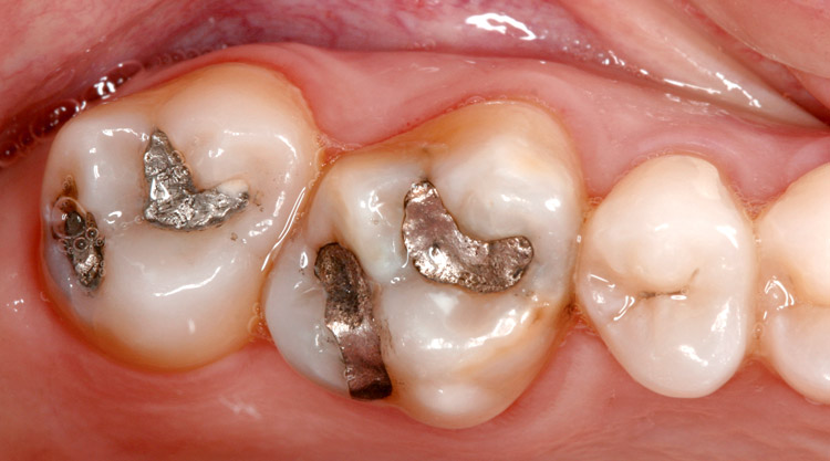 Ce trebuie sa stim despre plombele dentare
