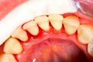 Sangerarea gingivala