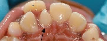 Intruzia dintilor permanenti